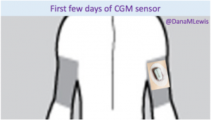 Dana Lewis_first day CGM sensor illustration